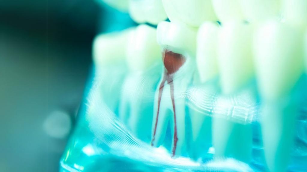 How Long Will My Root Canal Last?