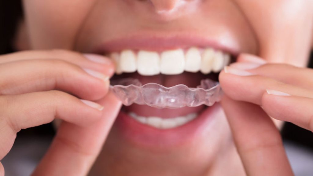 Person Wearing Invisalign Aligner